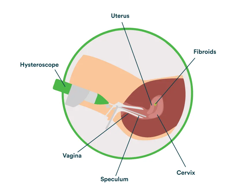 Hysteroscopy