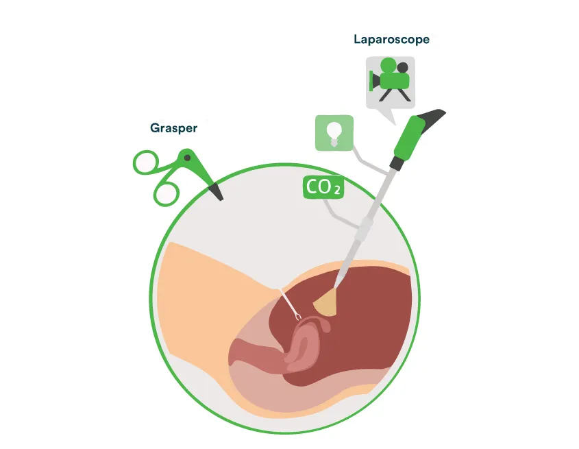 Laparoscopy